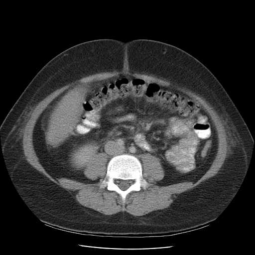 File:Non-Hodgkin lymphoma involving pelvis (Radiopaedia 21281-21197 A 38).jpg