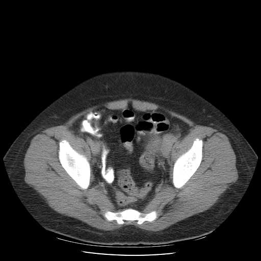 File:Non-Hodgkin lymphoma involving pelvis (Radiopaedia 21281-21197 B 53).jpg
