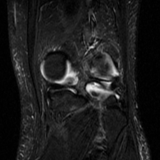 File:Non-displaced patella fracture (Radiopaedia 15932-15582 Coronal STIR 18).jpg