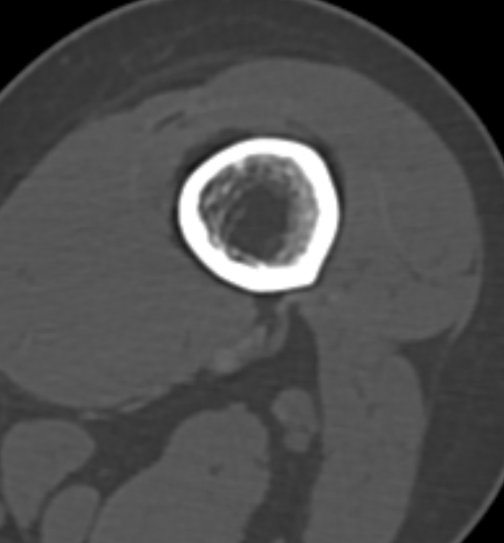 Non-ossifying fibroma - femur (Radiopaedia 82786-97042 Axial bone window 31).jpg