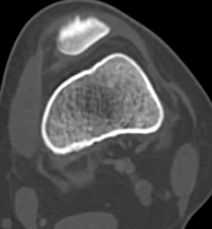 Non-ossifying fibroma - femur (Radiopaedia 82786-97042 Axial bone window 47).jpg