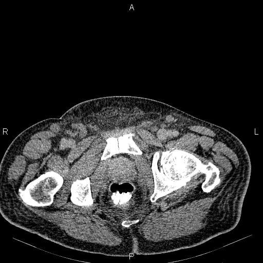 Non Hodgkin lymphoma in a patient with ankylosing spondylitis (Radiopaedia 84323-99621 Axial C+ delayed 83).jpg