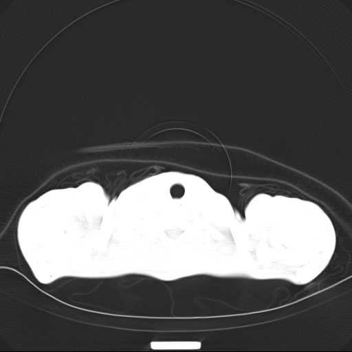 File:Non hodgkin lymphoma of the mediastinum (Radiopaedia 20814-20729 Axial lung window 2).jpg