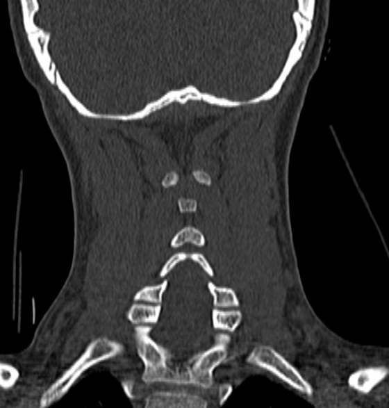 File:Normal CT cervical spine - 12-year-old (Radiopaedia 55352-61775 Coronal bone window 163).jpg