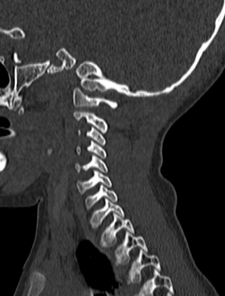 Normal CT cervical spine - pediatric (Radiopaedia 52549-58462 Sagittal bone window 47).jpg