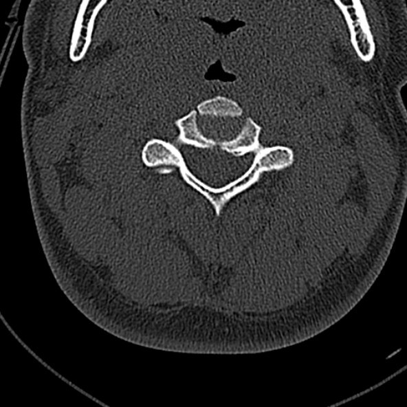 Normal CT of the cervical spine (Radiopaedia 53322-59305 Axial bone window 101).jpg