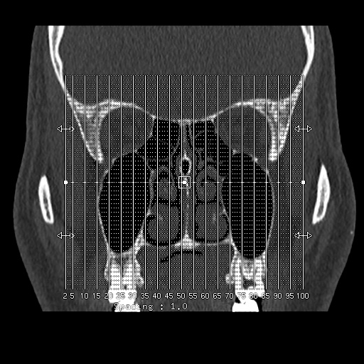 Normal CT paranasal sinuses (Radiopaedia 42286-45390 Sagittal bone window 1).jpg