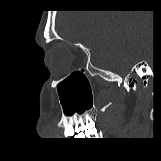Normal CT paranasal sinuses (Radiopaedia 42286-45390 Sagittal bone window 79).jpg