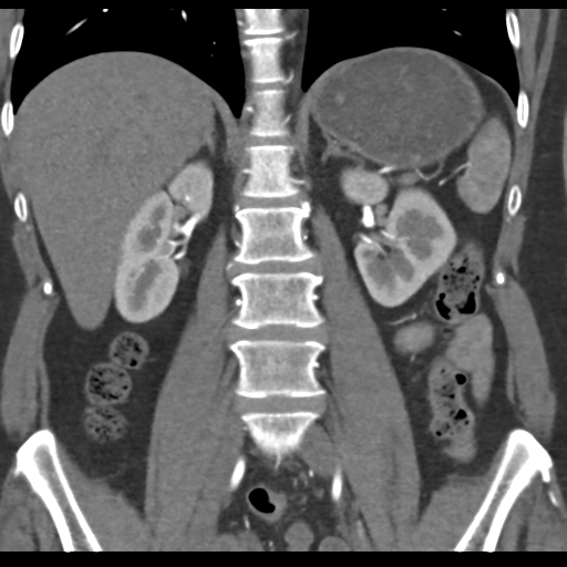 File:Normal CT renal artery angiogram (Radiopaedia 38727-40889 B 46).png