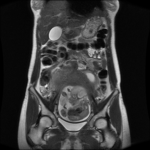 File:Normal MRI abdomen in pregnancy (Radiopaedia 88001-104541 Coronal T2 14).jpg