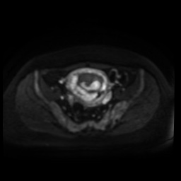 Normal MRI abdomen in pregnancy (Radiopaedia 88005-104548 Axial DWI 58).jpg
