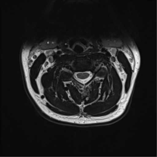 File:Normal MRI cervical spine (infection protocol) (Radiopaedia 53916-60039 Axial T2 22).png