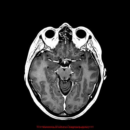 Normal adult brain MRI (non-enhanced and contrast-enhanced) (Radiopaedia 75262-86379 Axial T1 C+ 90).jpg