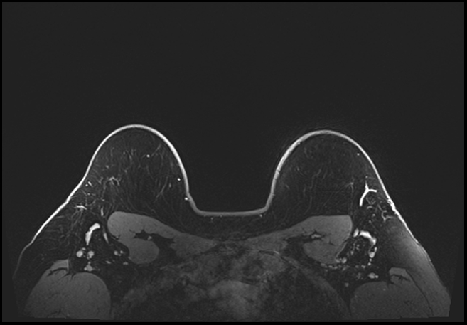 Normal breast MRI - dense breasts (Radiopaedia 80454-93850 C 196).jpg