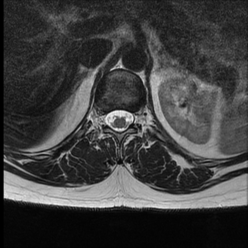 File:Normal cervical and thoracic spine MRI (Radiopaedia 35630-37156 H 7).png