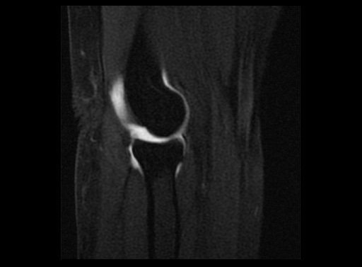 File:Normal elbow arthrograms (Radiopaedia 75550-86805 Sagittal T1 fat sat 6).jpg