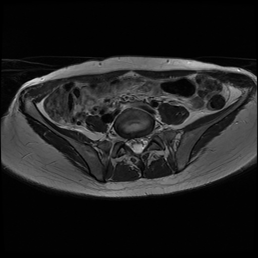 File:Normal female pelvis MRI (retroverted uterus) (Radiopaedia 61832-69933 Axial T2 5).jpg