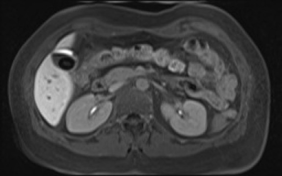 File:Normal hepatobiliary phase liver MRI (Radiopaedia 58968-66230 A 57).jpg
