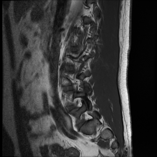 File:Normal lumbar spine MRI (Radiopaedia 35543-37039 Sagittal T1 11).png