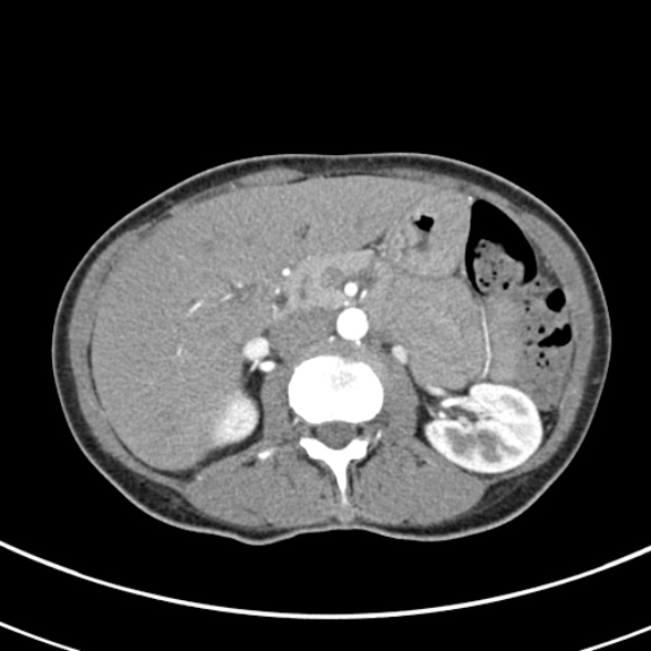 File:Normal multiphase CT liver (Radiopaedia 38026-39996 B 31).jpg