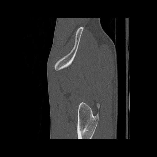 Normal pelvis (Radiopaedia 51473-57238 Sagittal bone window 21).jpg