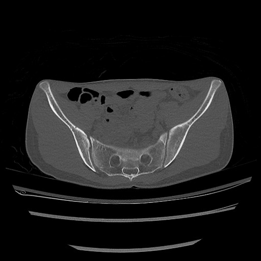 Normal pelvis CT (Radiopaedia 51471-57236 Axial bone window 38).jpg