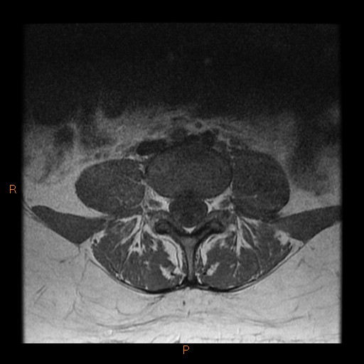 File:Normal spine MRI (Radiopaedia 77323-89408 Axial T1 14).jpg