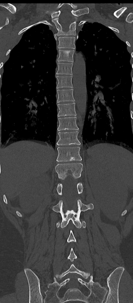 Normal thoracolumbar spine (Radiopaedia 43822-47309 Coronal bone window 57).png