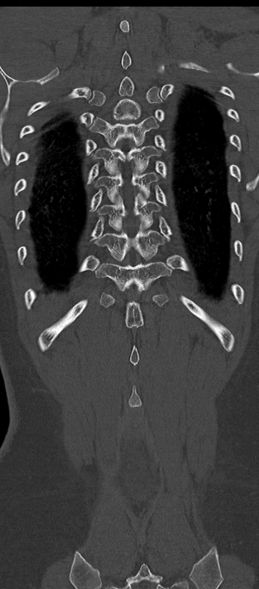 Normal thoracolumbar spine (Radiopaedia 43822-47309 Coronal bone window 76).png