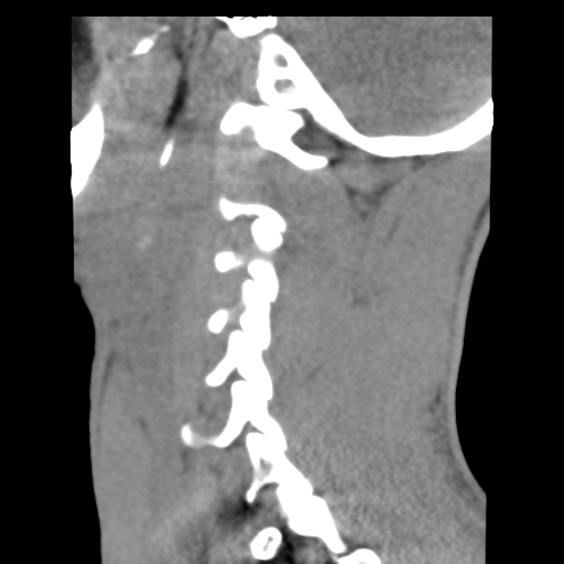 File:Normal trauma cervical spine (Radiopaedia 41017-43760 B 23).png