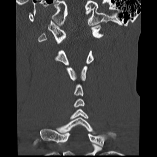 File:Normal trauma cervical spine (Radiopaedia 41017-43760 Coronal bone window 26).png