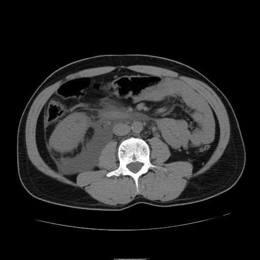 File:Obstructed kidney with perinephric urinoma (Radiopaedia 26889-27066 Axial non-contrast 29).jpg