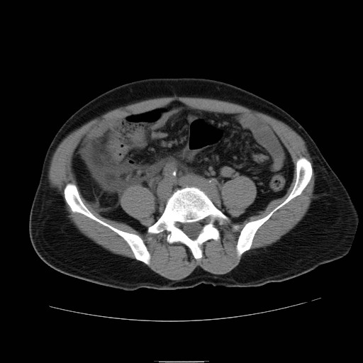 File:Obstructed kidney with perinephric urinoma (Radiopaedia 26889-27066 Axial non-contrast 43).jpg