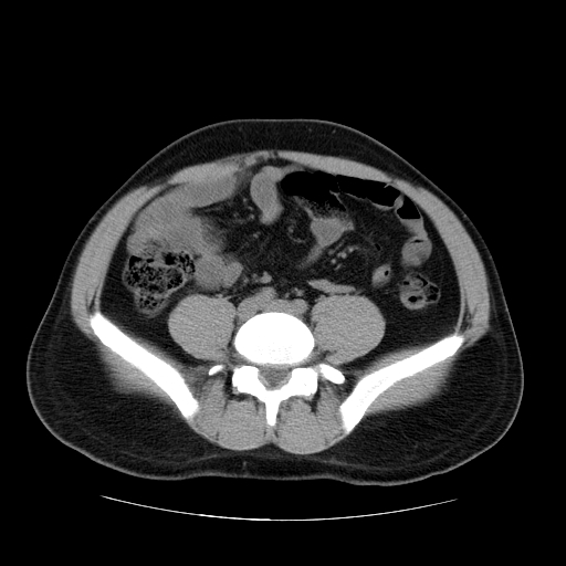 File:Obstructing ureteric calculus (Radiopaedia 18615-18514 Axial non-contrast 36).jpg