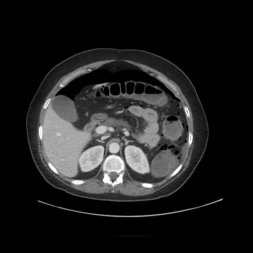 Obstructive distal colonic adenocarcinoma causing cecal perforation (Radiopaedia 86830-102989 A 63).jpg