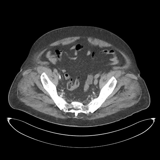 File:Obstructive pyelonephritis (Radiopaedia 46411-50844 Axial non-contrast 65).png
