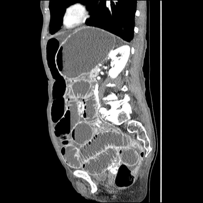 Obturator hernia causing small bowel obstruction (Radiopaedia 65522-74612 C 36).jpg