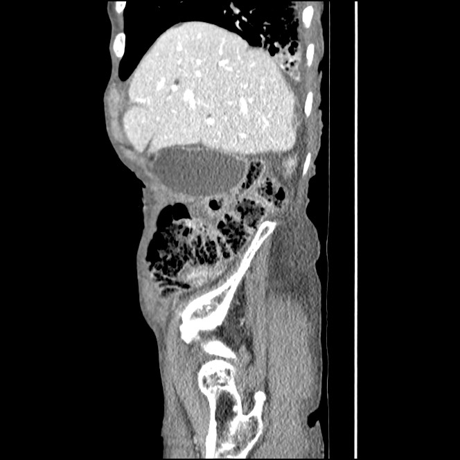Obturator hernia causing small bowel obstruction (Radiopaedia 65522-74612 C 80).jpg