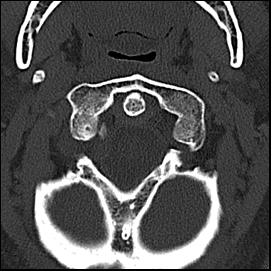 Occipital condyle fracture (type 1) (Radiopaedia 87670-104084 Axial bone window 15).jpg