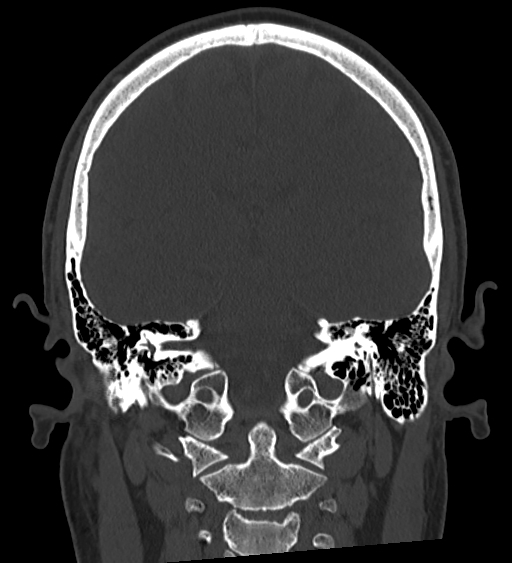 Occipital spur and Currarino type A atlas anomaly (Radiopaedia 87027-103285 Coronal bone window 91).jpg