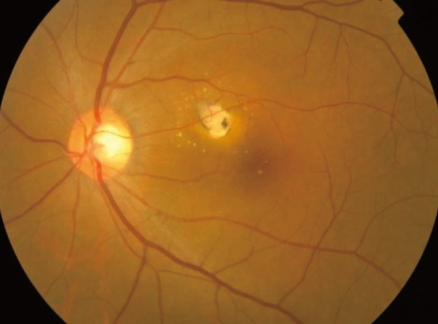 Fundus image of choroidal neovascularization in ocular toxoplasmosis
