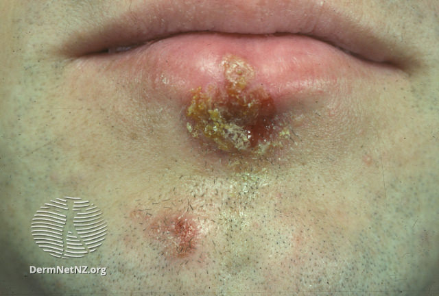 File:(DermNet NZ herpes-simplex-labialis-02).jpg