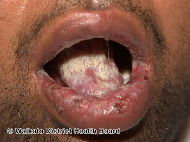 (DermNet NZ herpes-simplex-labialis-42).jpg