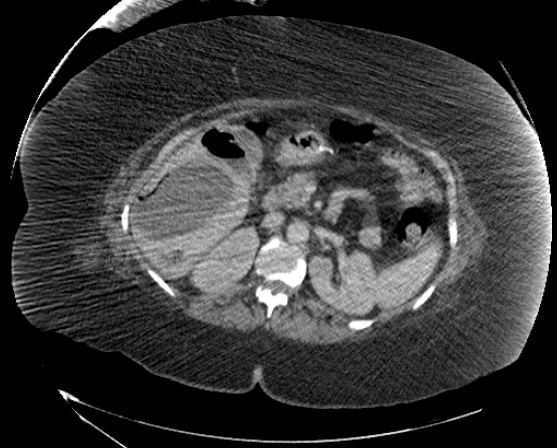File:Abdominal abscess - pre and post percutaneous drainage (Radiopaedia 60209-67816 Axial 41).png
