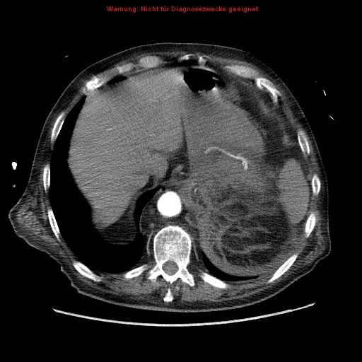 Abdominal aortic aneurysm- extremely large, ruptured (Radiopaedia 19882-19921 Axial C+ arterial phase 11).jpg