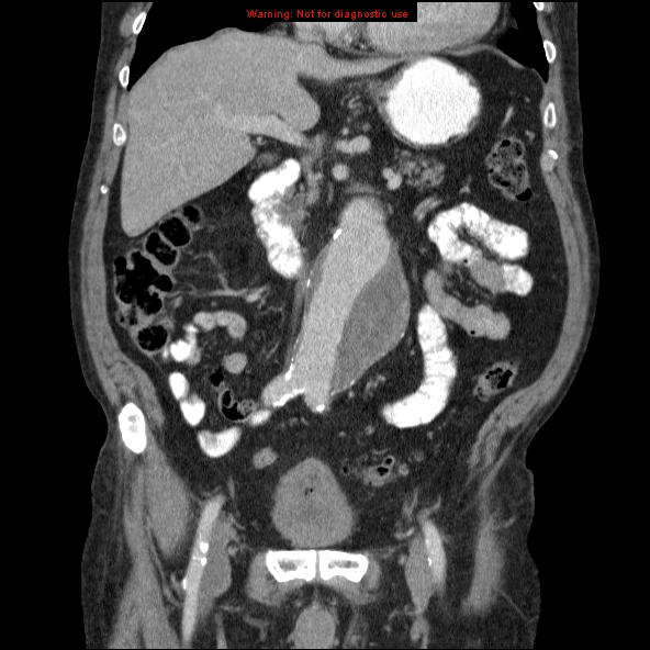 File:Abdominal aortic aneurysm (Radiopaedia 10122-10660 Coronal C+ portal venous phase 16).jpg