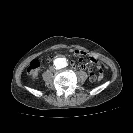 Abdominal aortic aneurysm (Radiopaedia 13341-13340 Axial C+ arterial phase 141).jpg