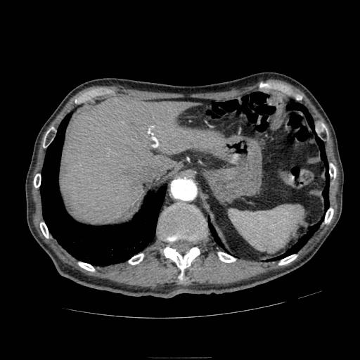 File:Abdominal aortic aneurysm (Radiopaedia 13341-13340 Axial C+ arterial phase 31).jpg