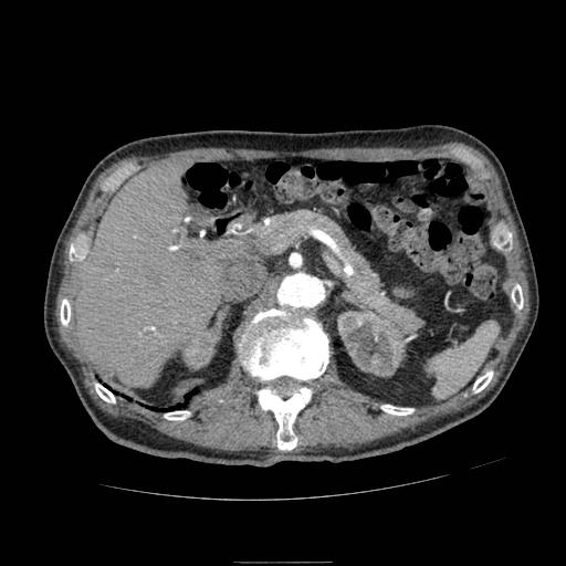 Abdominal aortic aneurysm (Radiopaedia 13341-13340 Axial C+ arterial phase 55).jpg