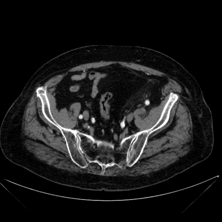 Abdominal aortic aneurysm (Radiopaedia 25855-26001 Axial C+ arterial phase 108).jpg